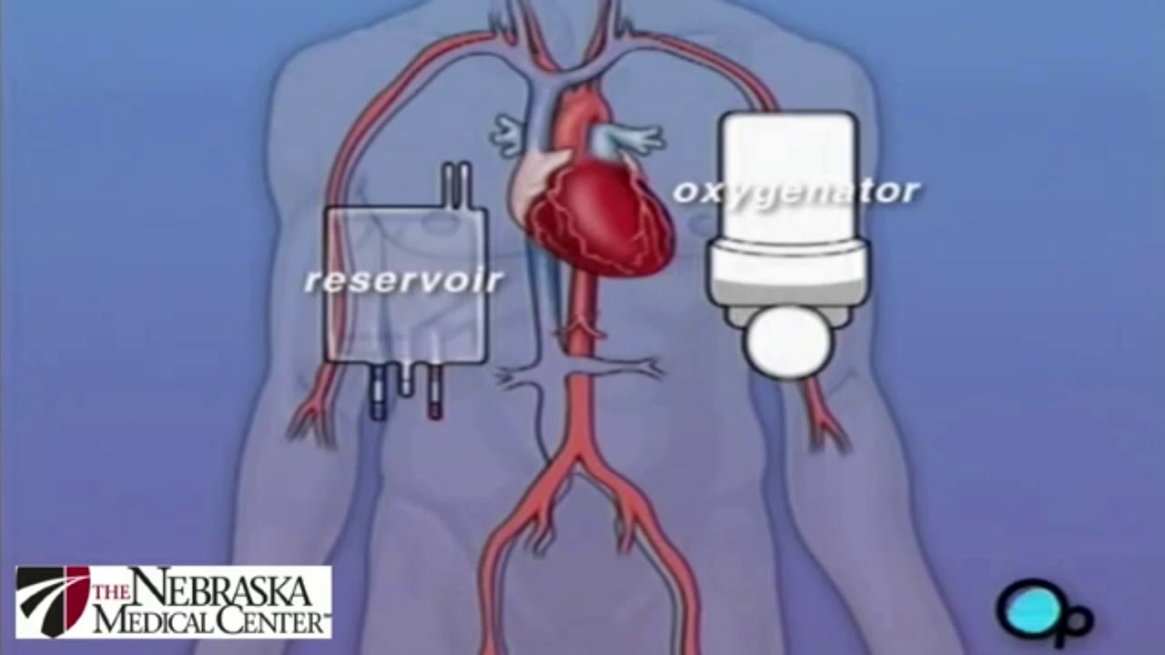 АКШ-аортокоронарное шунтирование