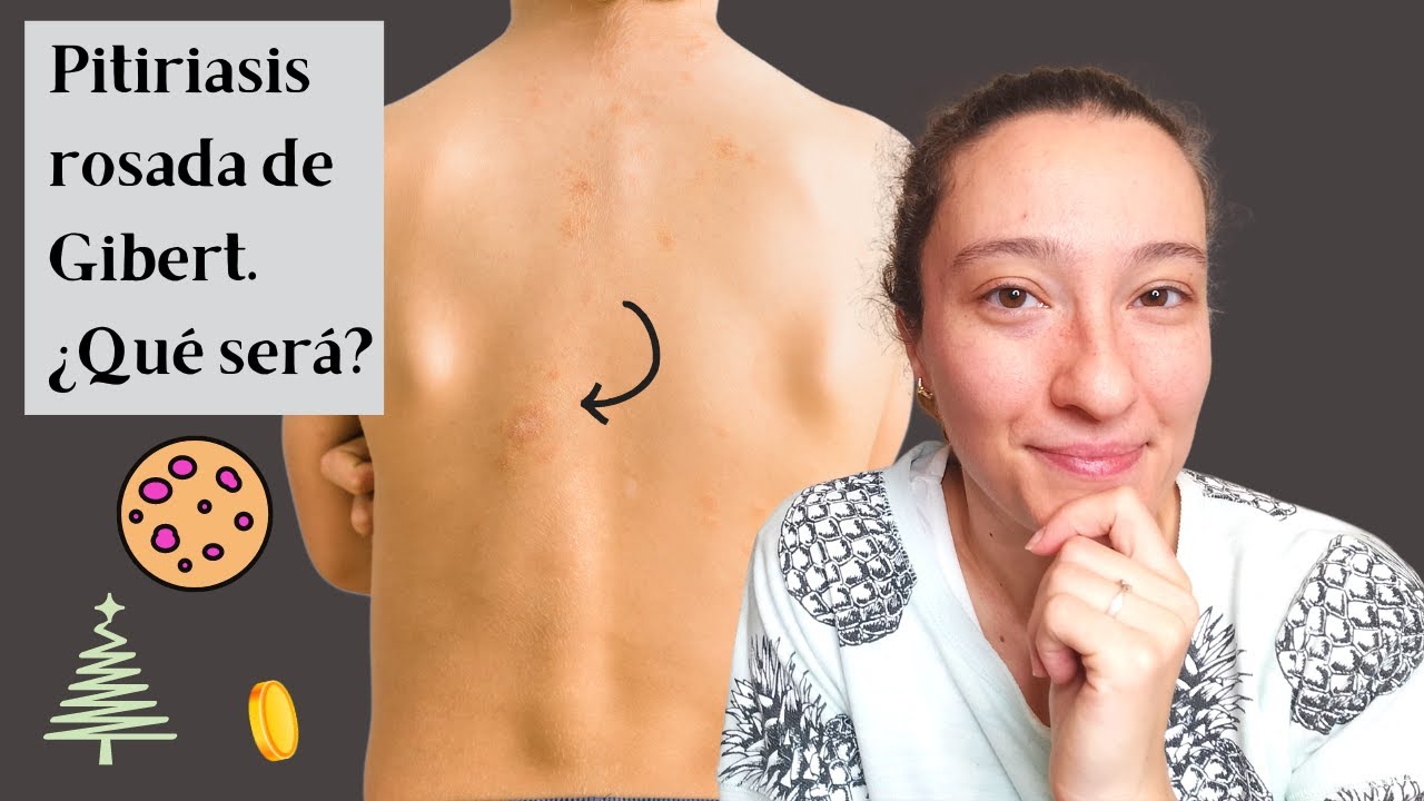 🪙PITIRIASIS ROSADA de Gibert en niños y adultos 🤷