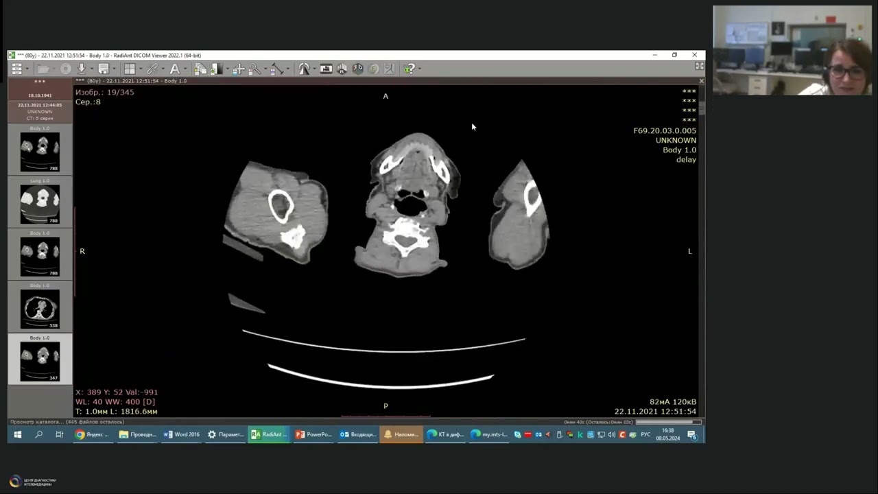 КТ в дифференциальной диагностике образований печени с кольцевидным паттерном контрастирования