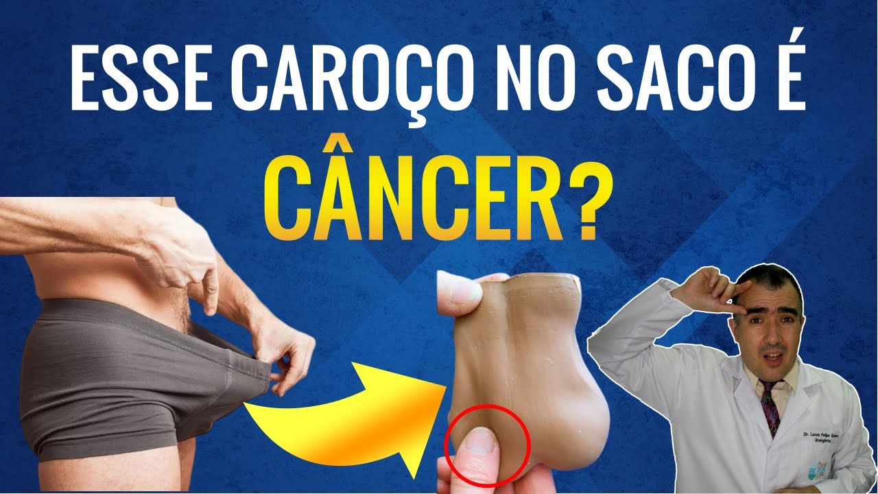 Será que esse nódulo que palpei no meu saco é ou não um câncer de testículo?