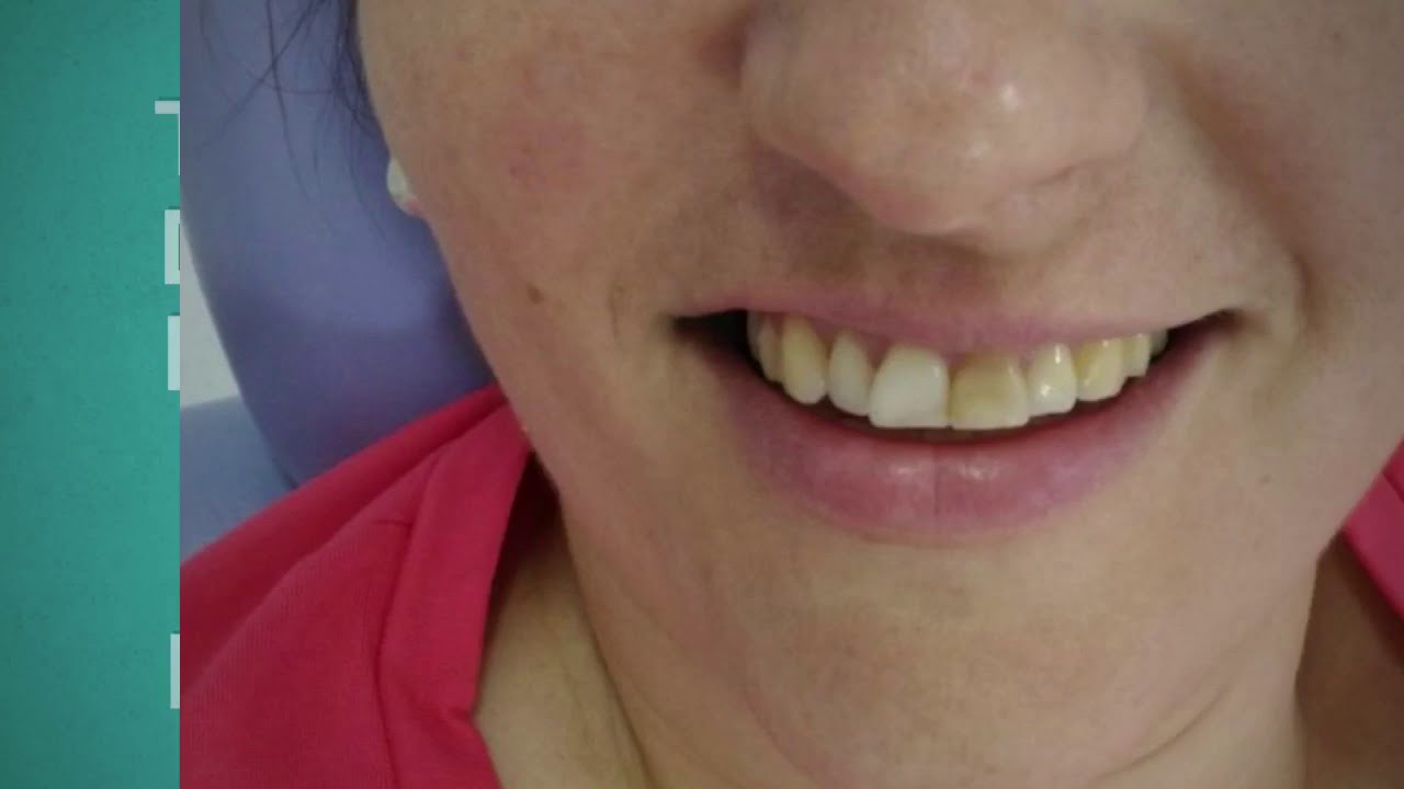 Transforma&ccedil;&atilde;o do sorriso - facetas em resina composta