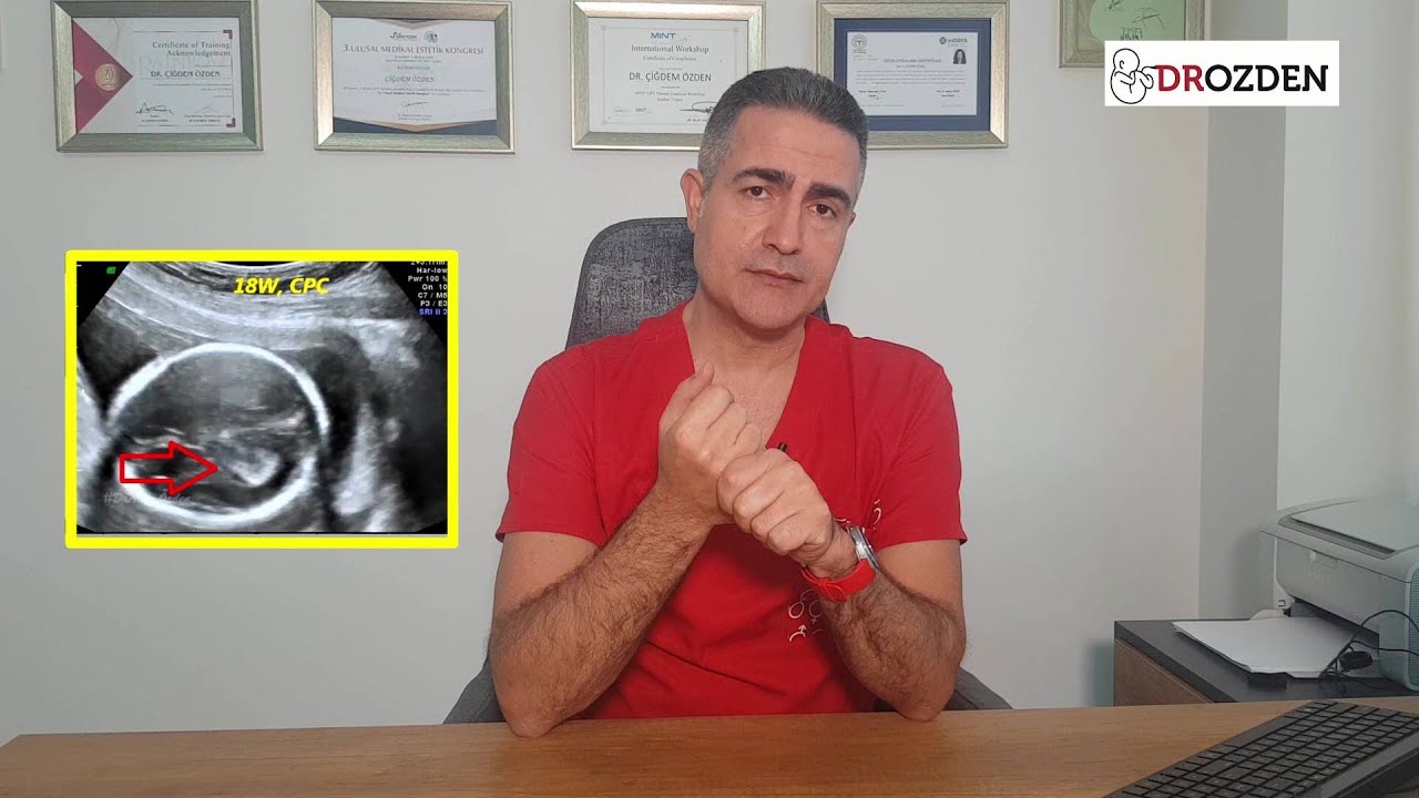 KOROİD PLEKSUS KİSTİ