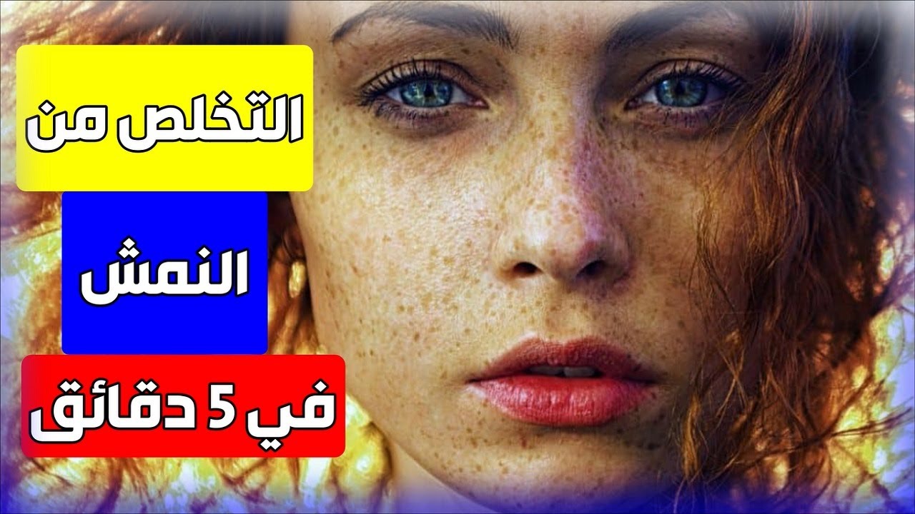 علاج للنمش سريع المفعول للتخلص من النمش والبقع البنيه في الوجه مجرب وآمن طبيعي في 6 أيام