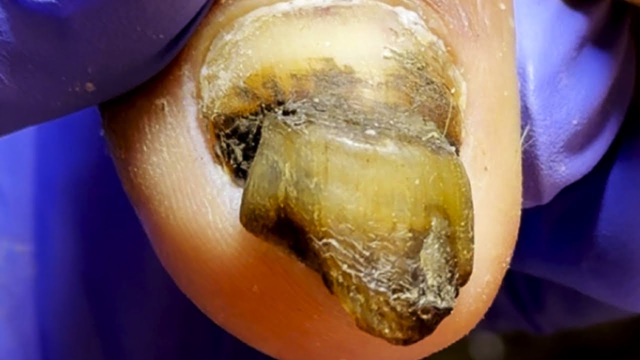 Oh My God! Dirty And Thick Onychomycosis【Dr. Liu's Pedicur】