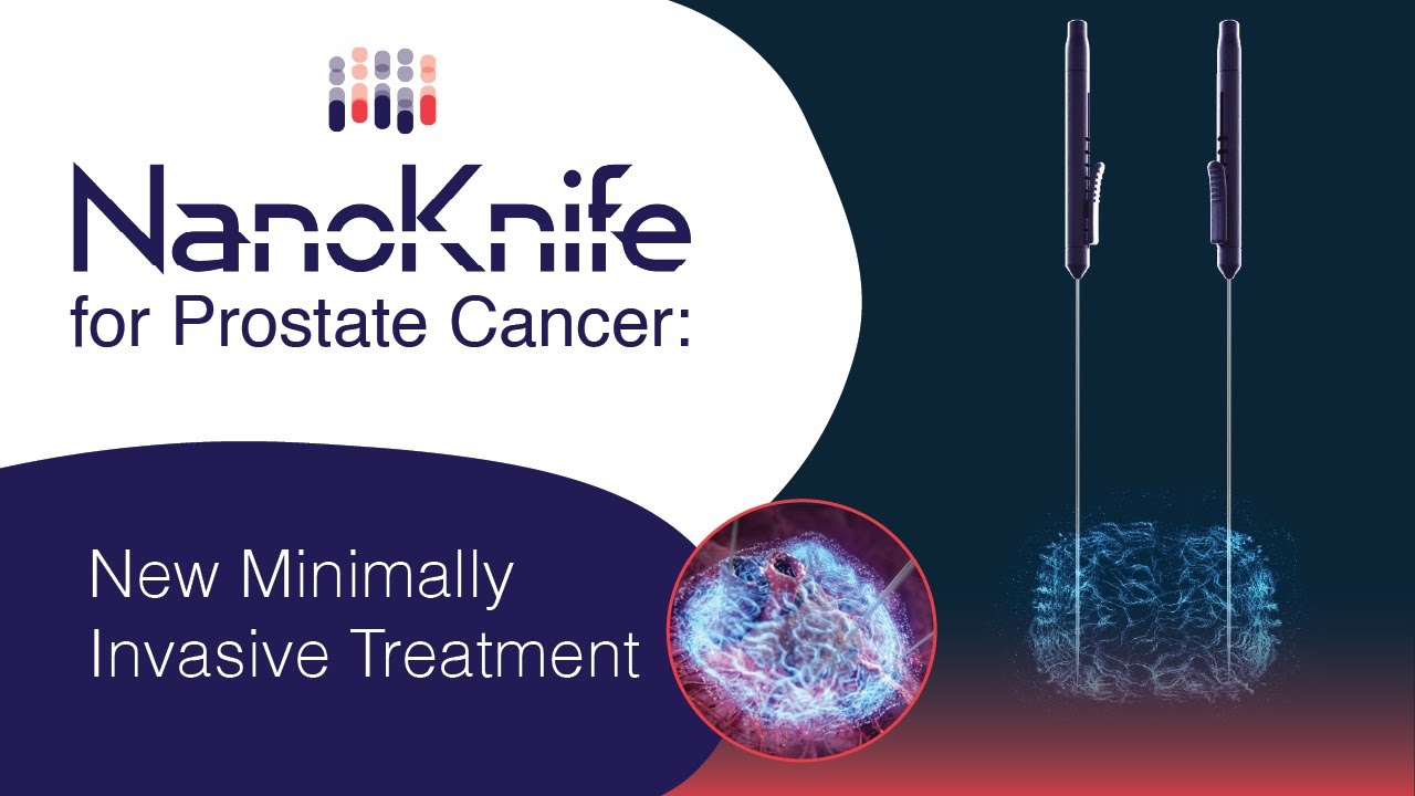 Nanoknife for Prostate Cancer: New Minimally Invasive Treatment