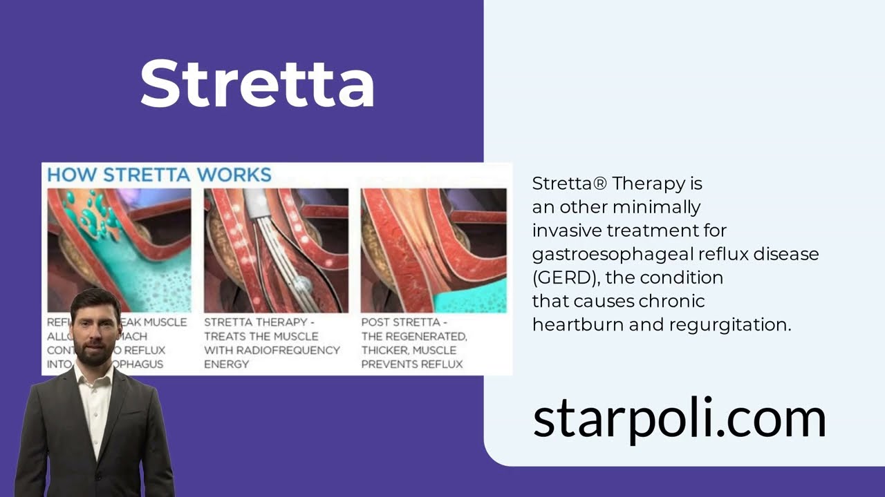 Stretta Therapy for Reflux