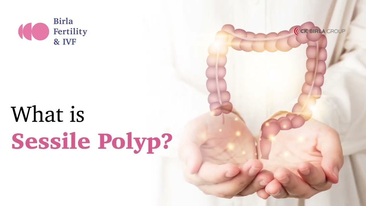 What is Sessile Polyp | Birla Fertility & IVF