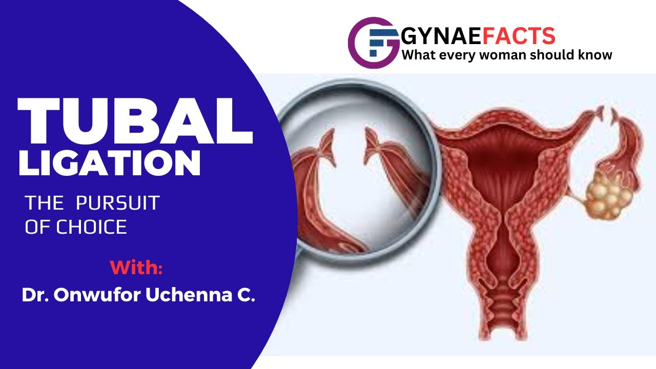 TUBAL LIGATION: THE PURSUIT OF CHOICE