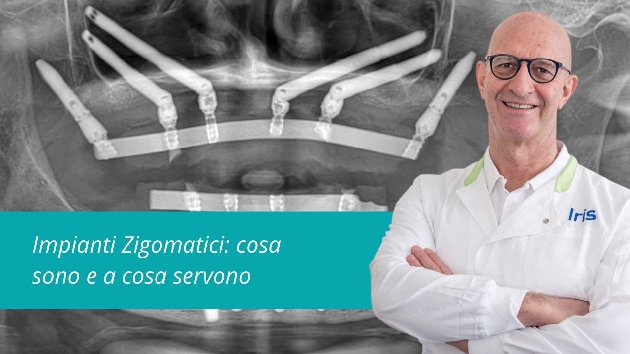 Gli impianti zigomatici: cosa sono e a cosa servono.