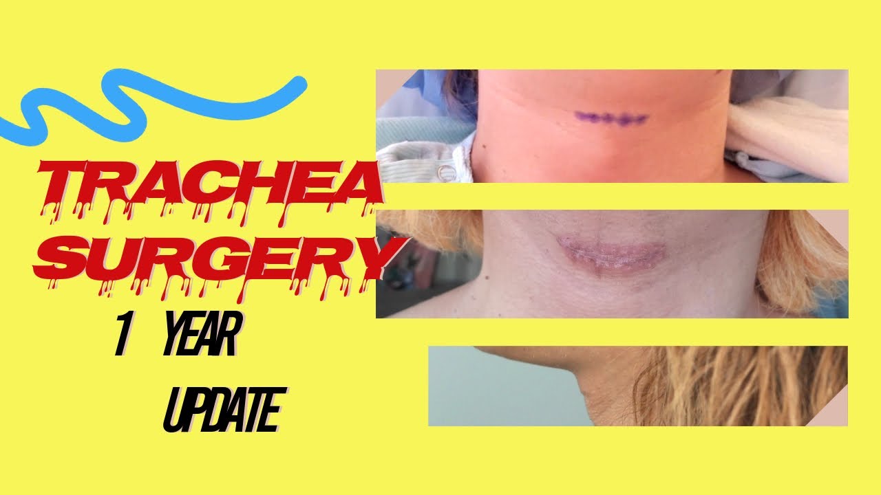 Trachea Shave 1YR Update// Facial Feminization Surgery// FFS