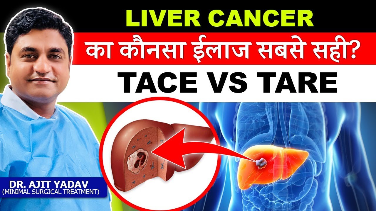 Liver Cancer के ईलाज में TACE Vs TARE Therapy: कौन सा Treatment आपके लिए बेहतर है?