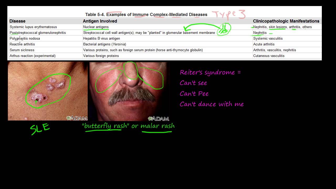 80P - Examples of Immune Complex-Mediated Diseases, Type III Hypersensitivity