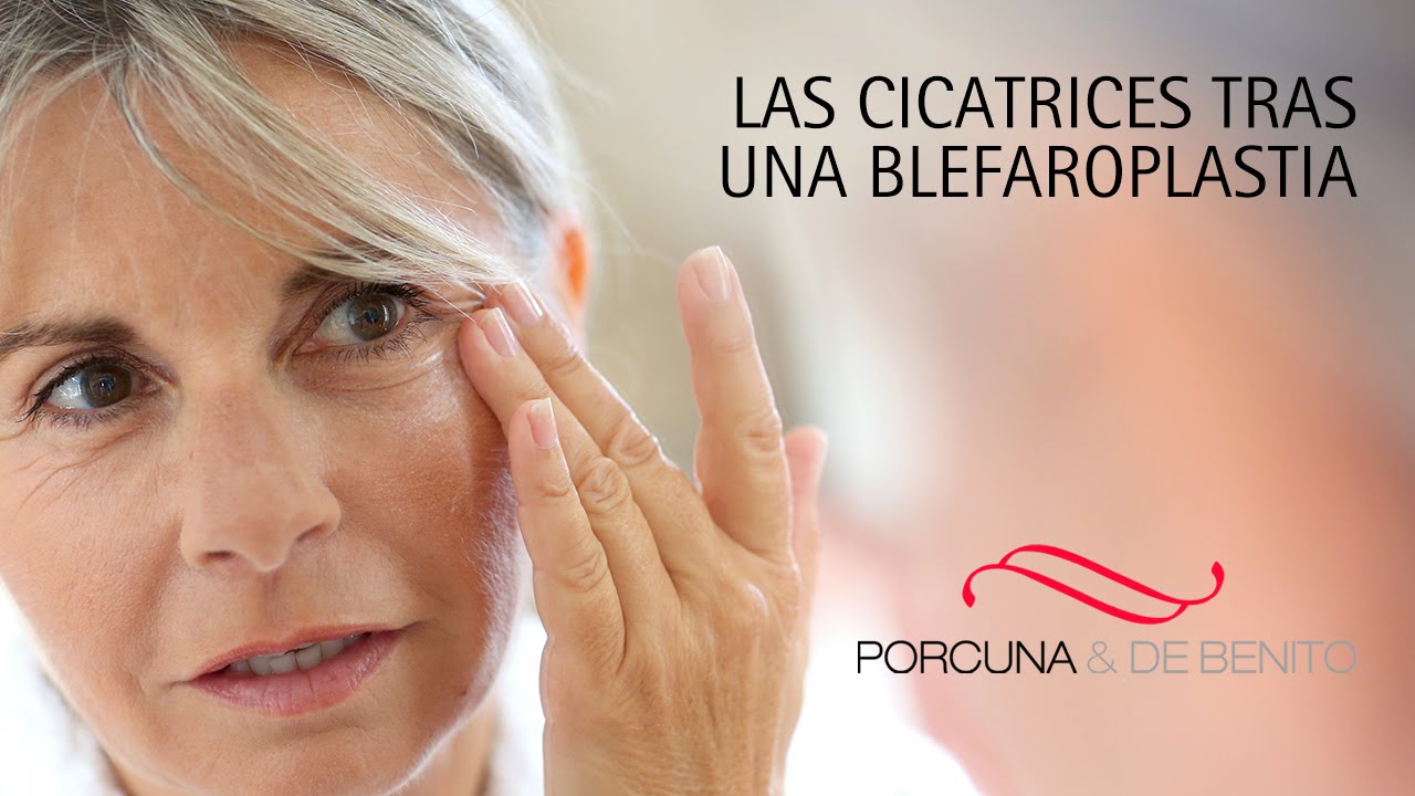 Las cicatrices tras una blefaroplastia