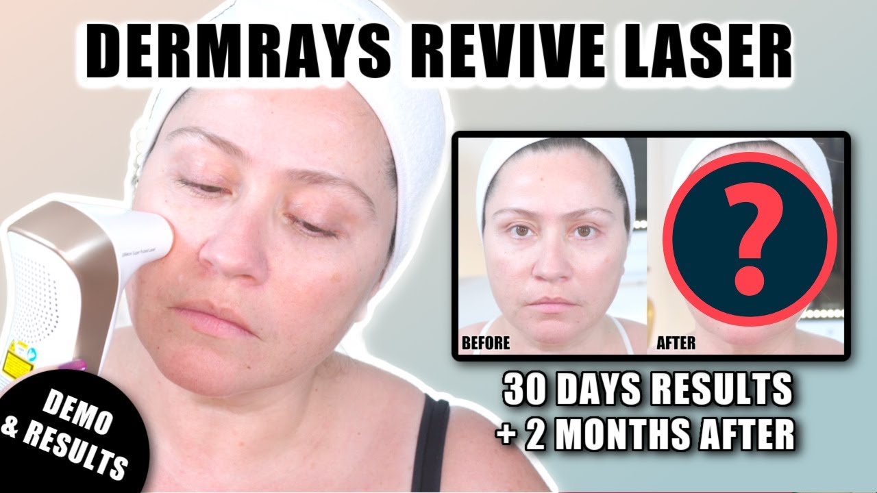 30 Days with Dermrays Revive Laser + 2 Months Later! 🤯 Shocking Before & After Results