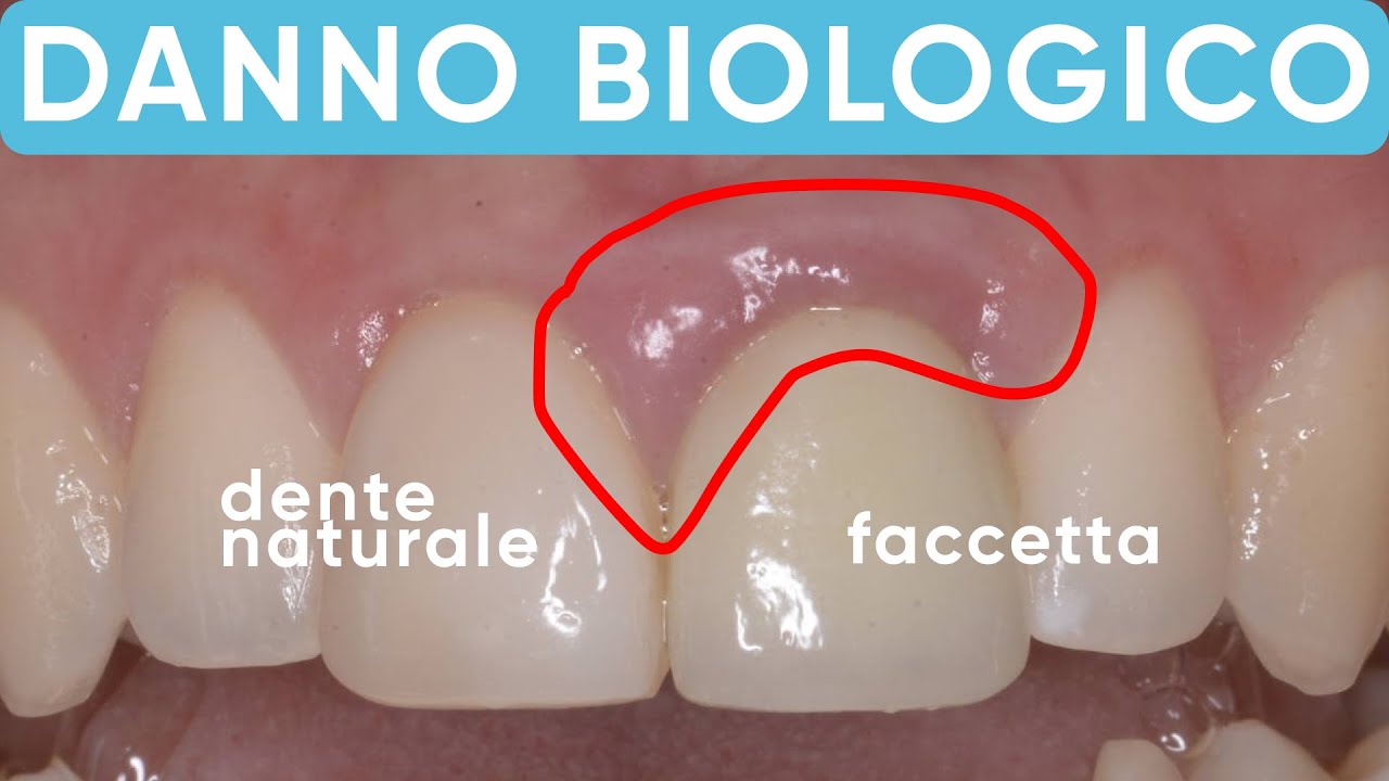 Le faccette dentali che distruggono le gengive | Caso clinico reale