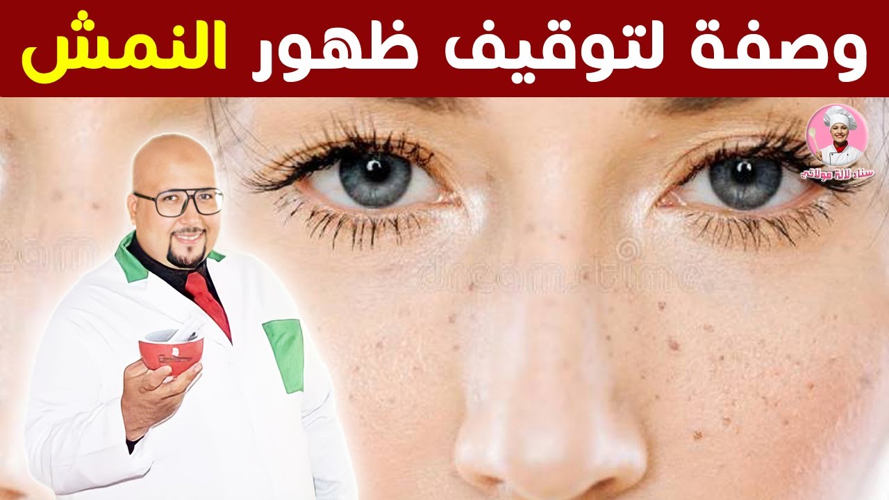 وصفة لتوقيف ظهور النمش في بشرة الوجه من عند الدكتور عماد ميزاب / Dr imad mizab