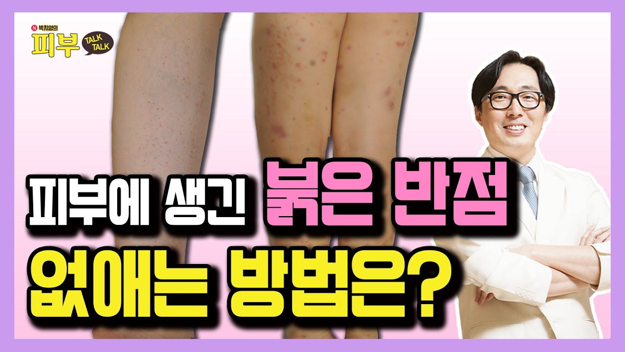 팔다리에 생기는 붉은 반점, 자반증의 종류와 생활 관리법 - 박치영의 피부 톡톡 #23 자반증 치료 방법