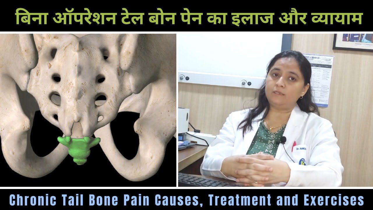 Chronic tail bone pain Causes, Treatment and Exercises II बिना ऑपरेशन टेल बोन पेन का इलाज और व्यायाम