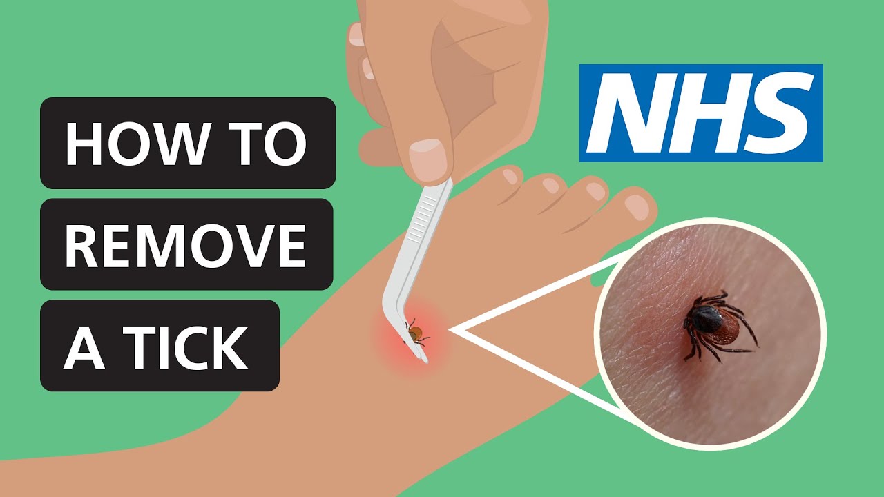How to remove a tick | NHS