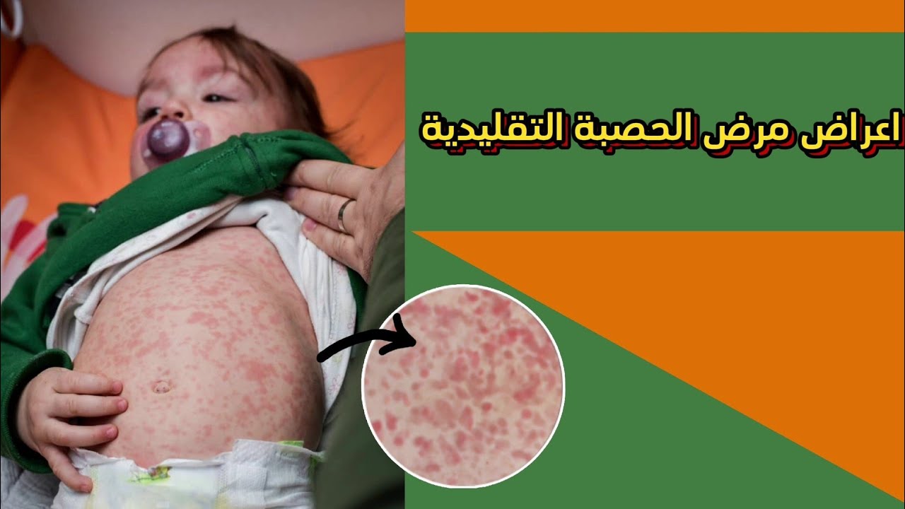 أعراض الاصابة بمرض الحصبة maesles