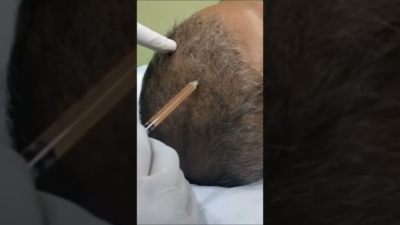 PRP Hair Loss Treatment: The Secret to Growing Your Hair Back? | platelet rich plasma