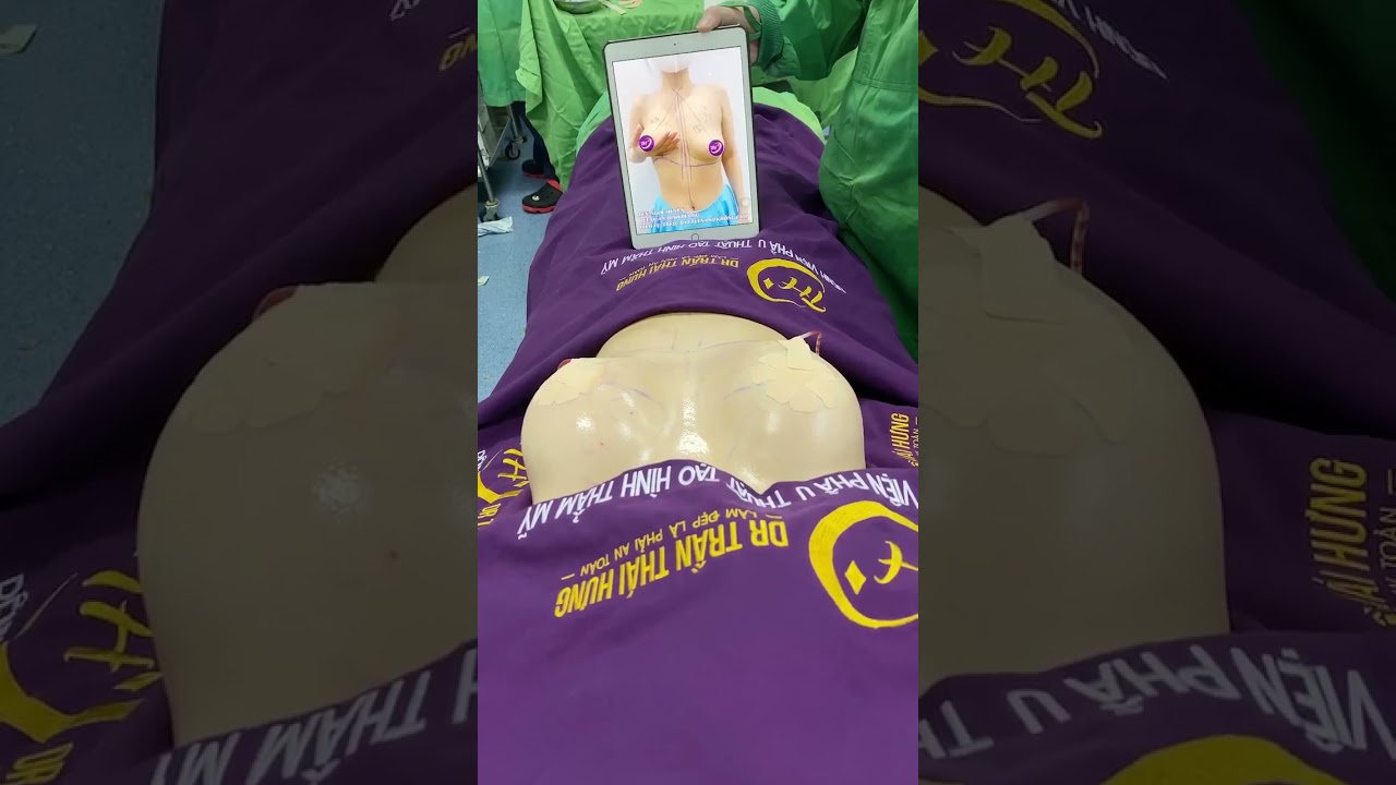 🔴 KẾT QUẢ TREO SA TRỄ KẾT HỢP NÂNG NGỰC ĐẶT TÚI CHO CHỊ NGỌC HUYỀN