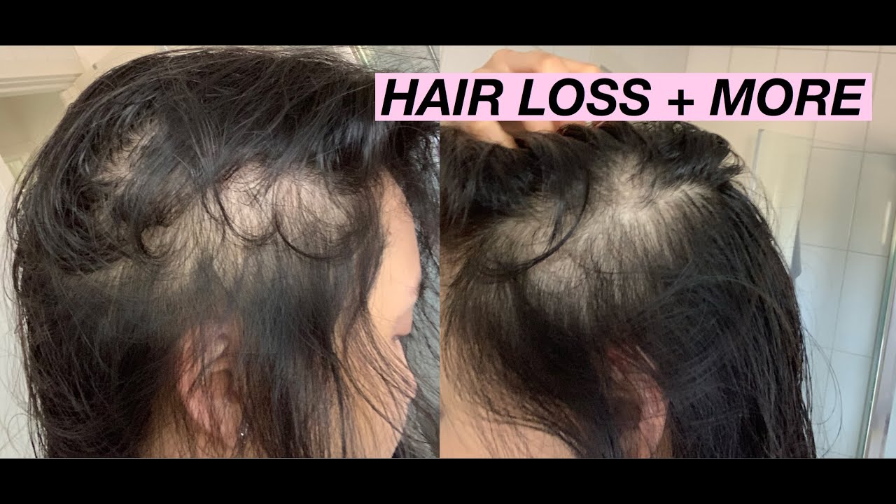 //PART 1: STORY ABOUT MY HAIR LOSS + HEALTH