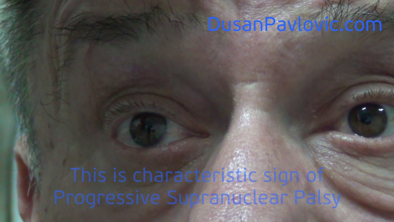 Progressive Supranuclear Palsy
