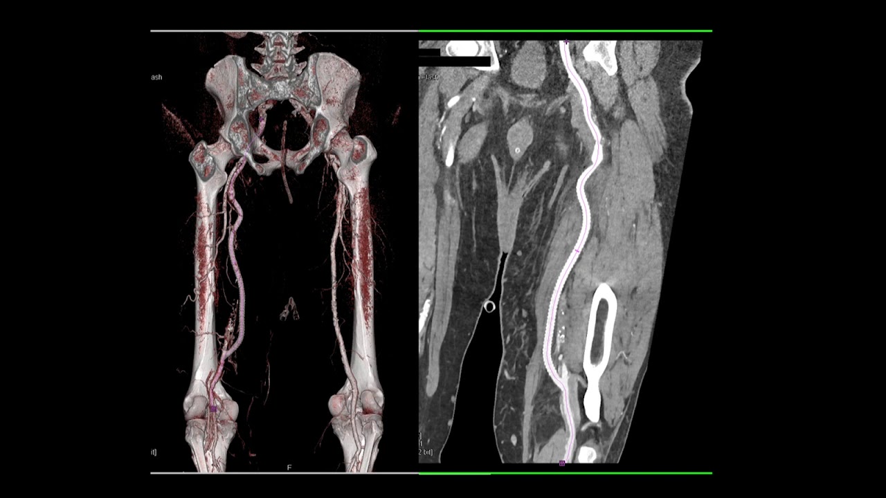 CT of Abdominal Aorta: Aneurysms, Dissections and Repair Part 1