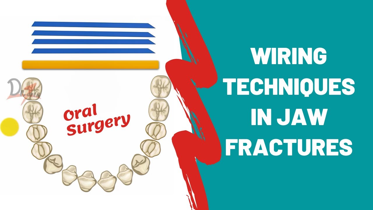 IVY Eyelet Wiring | Wiring Techniques | ORAL SURGERY