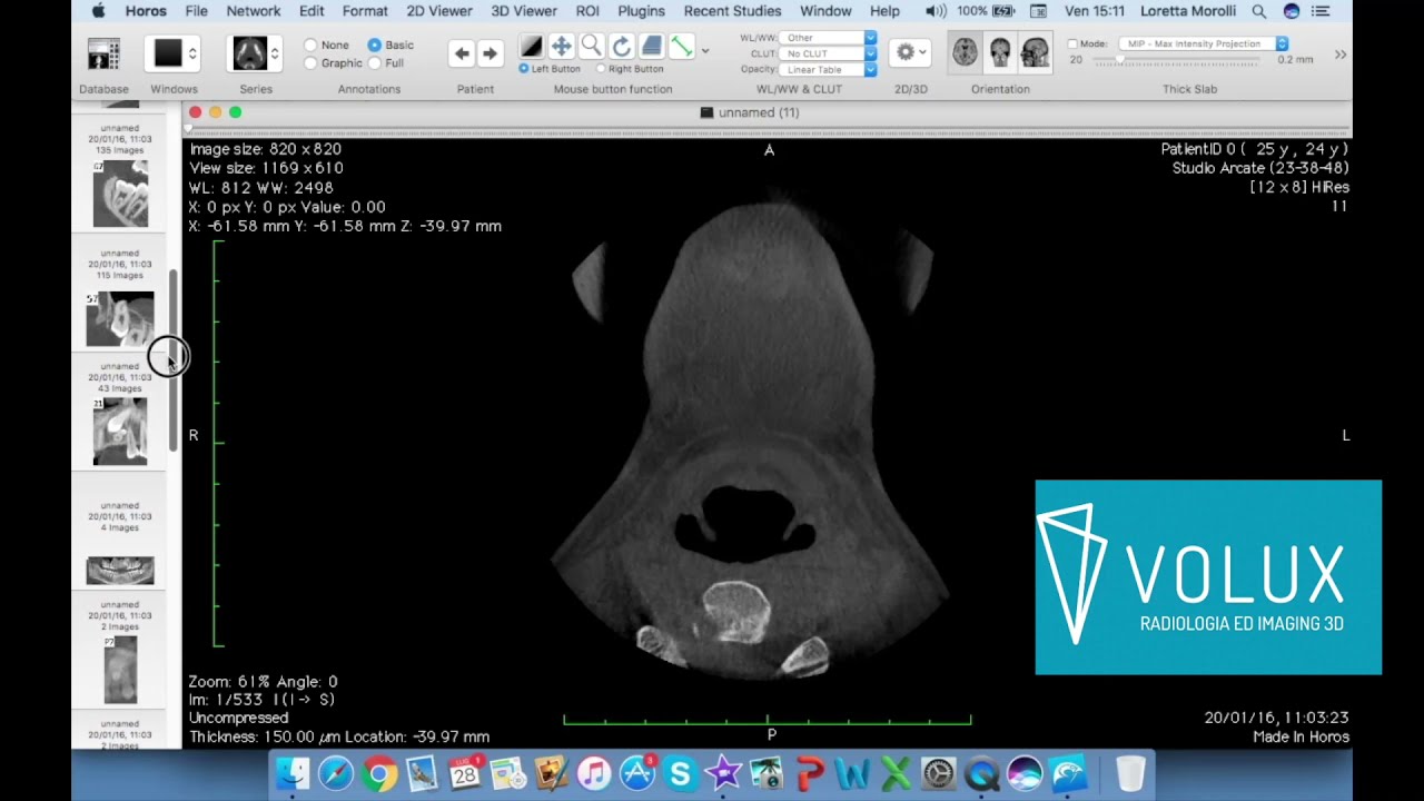 Volux - Tutorial Horos Viewer