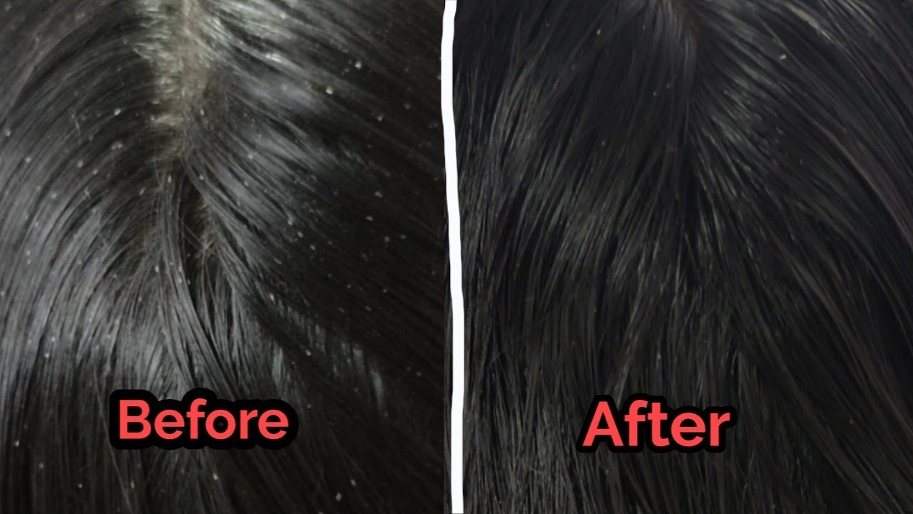 Nits and lice treatment Tamil 