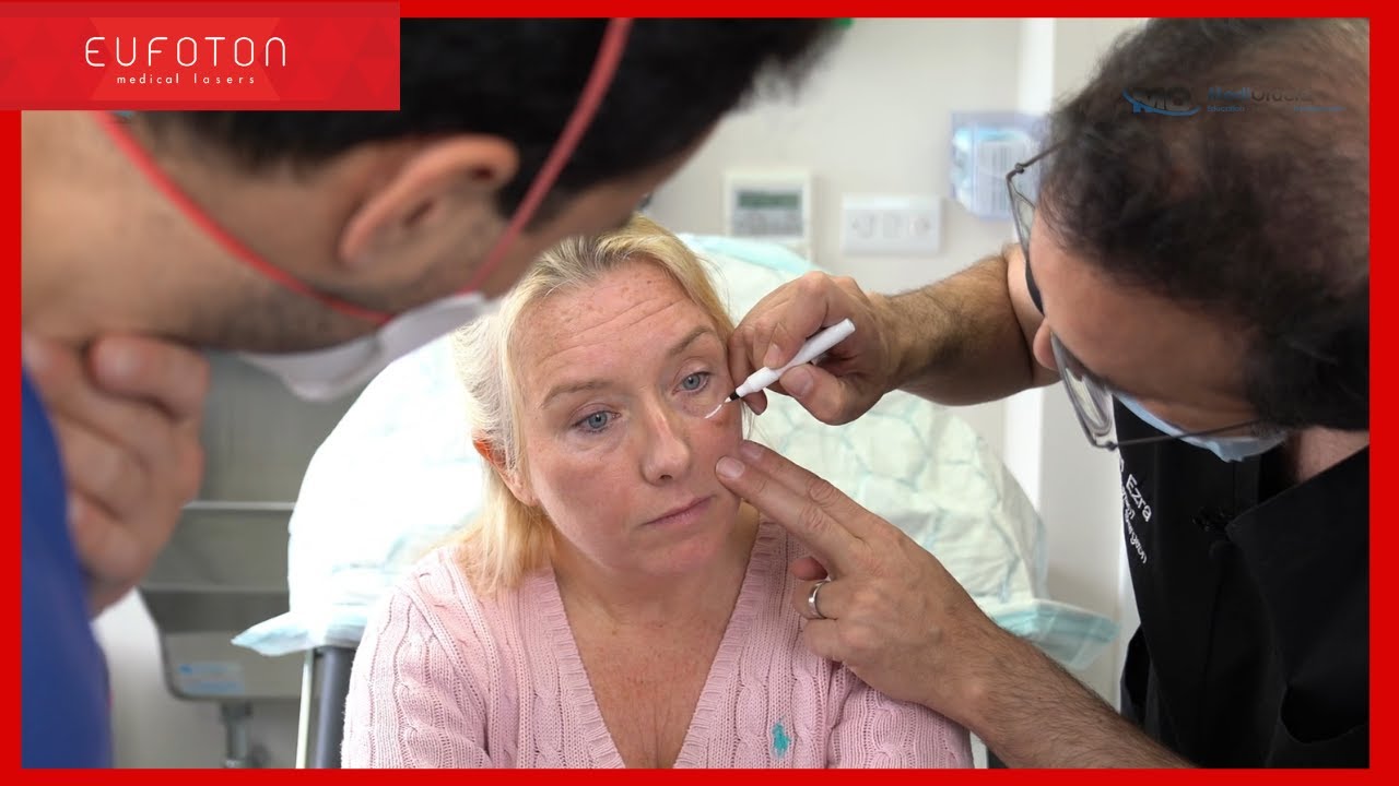 🇬🇧 Interview with Mr Daniel Ezra using Endolift® in the periorbital area | laser lifting [Eufoton®]