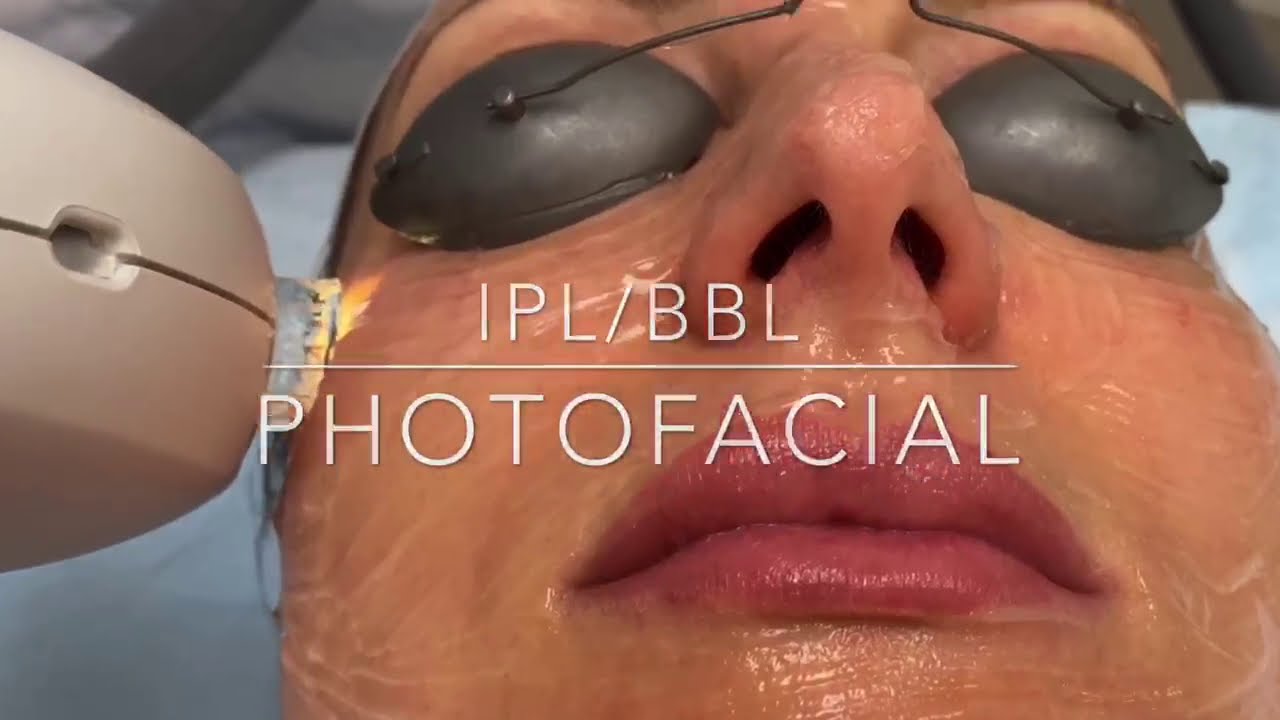 IPL/BBL Photofacial | Dr. Frank Fechner