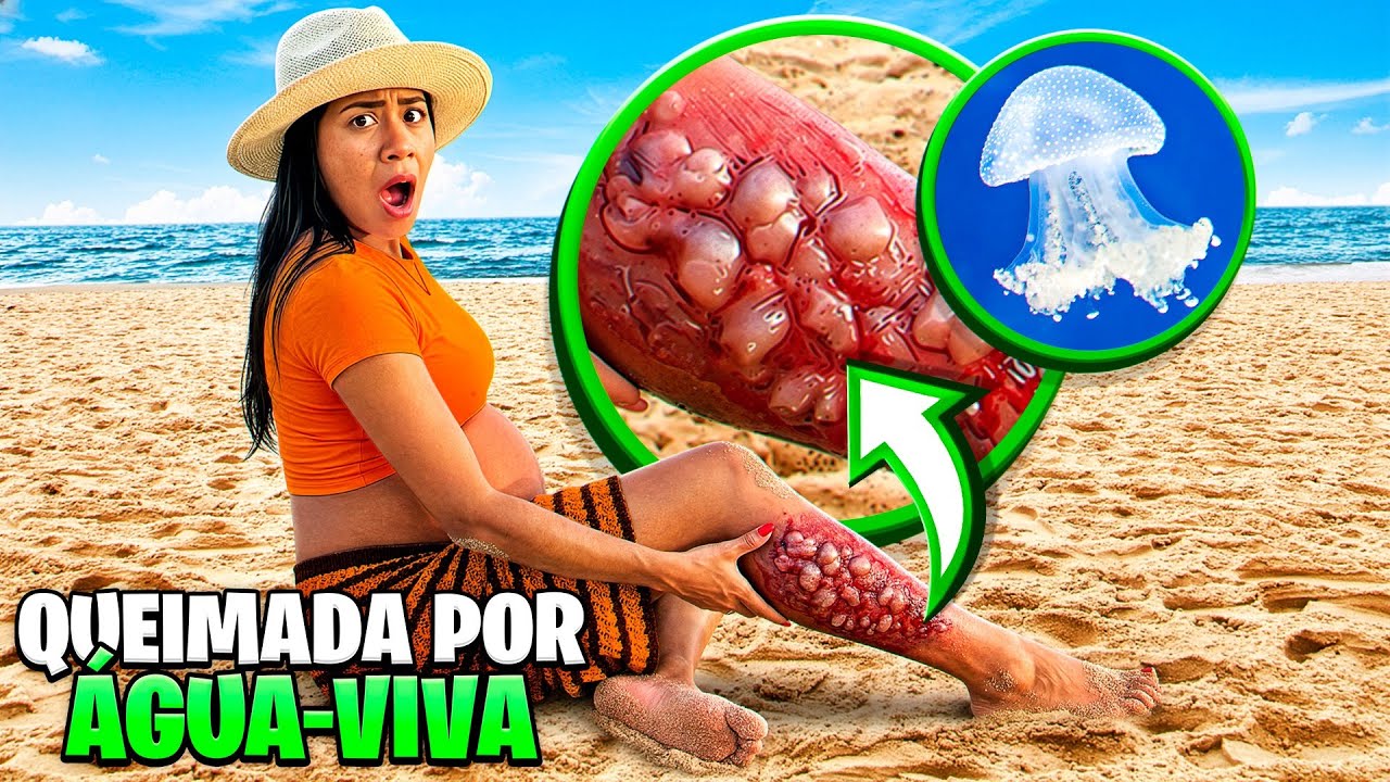 FUI QUEIMADA POR UMA &Aacute;GUA VIVA *chorei muito