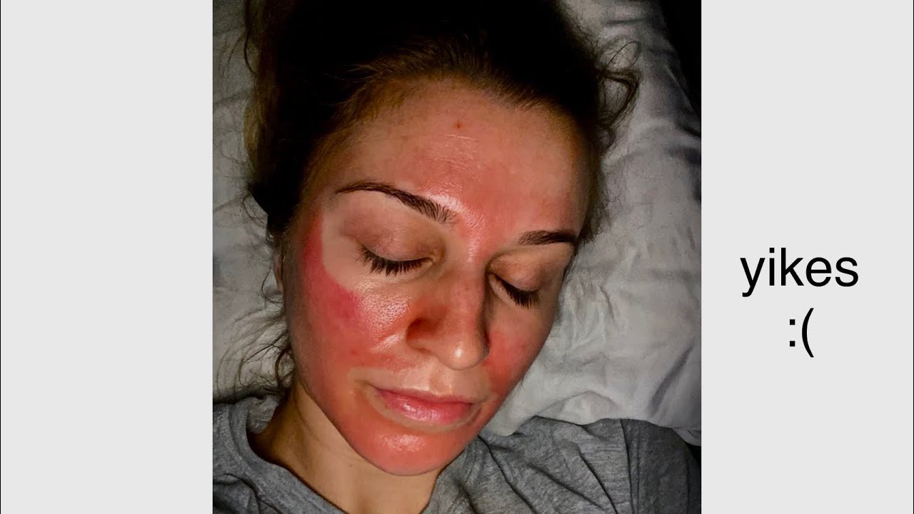 CHEMICAL PEEL/BURN- Facial Gone Wrong :(