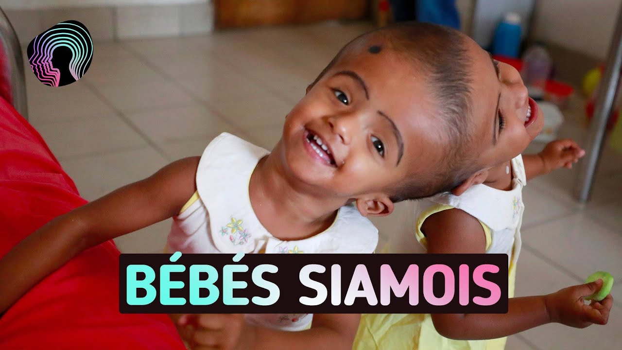 Comment vivre avec un jumeau siamois ?