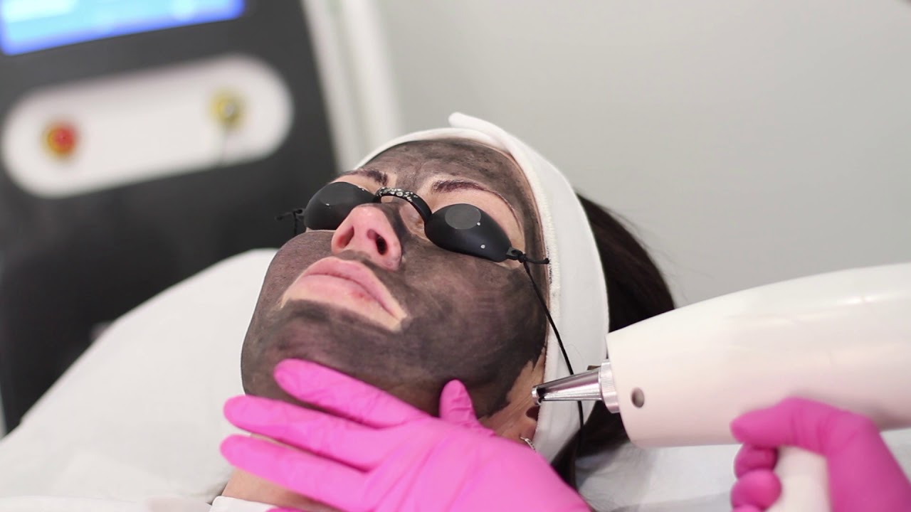 Best Facial Treatment! Carbon Laser Facial!