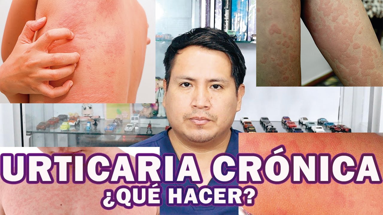 COMO ELIMINAR LA URTICARIA CRÓNICA | PASO A PASO