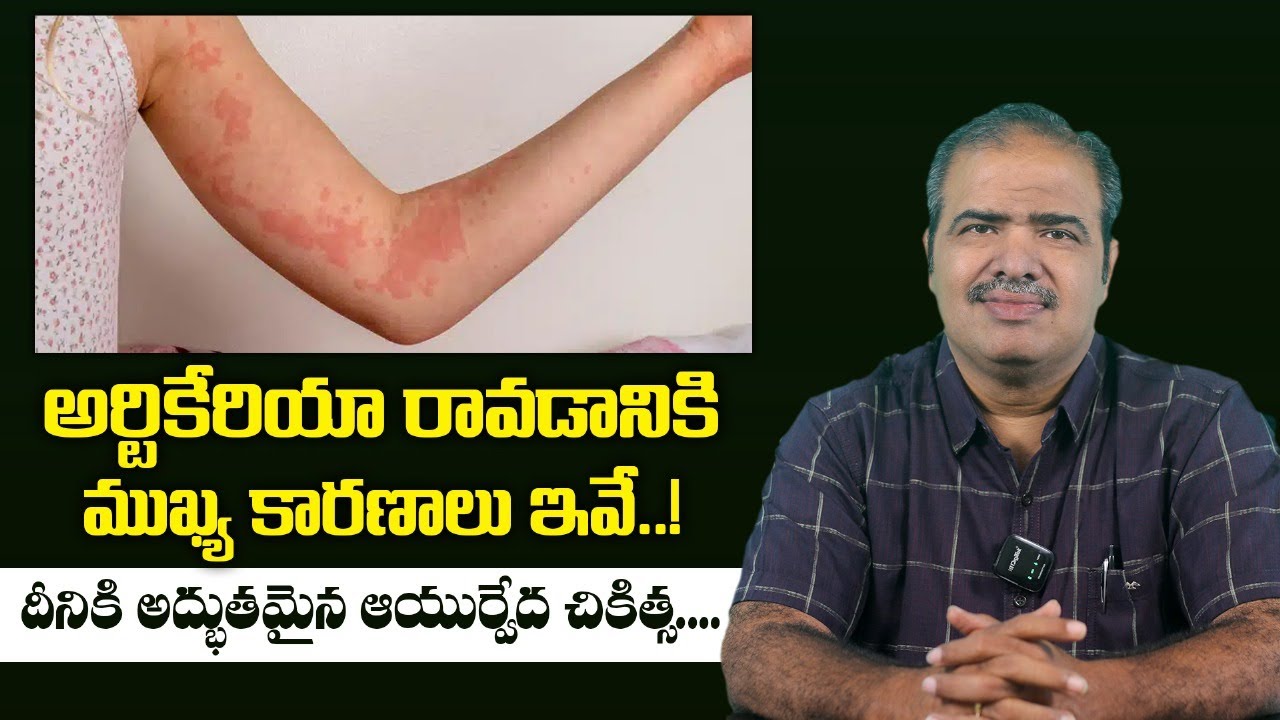 ఆర్టికేరియా సమస్య..? లక్షణాలు, కారణాలు, నివారణ | Urticaria Treatment Tips | Vardhan Ayurveda