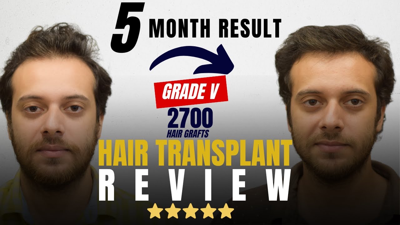 Cara Aesthetics - Hair Transplant honest testimonial.