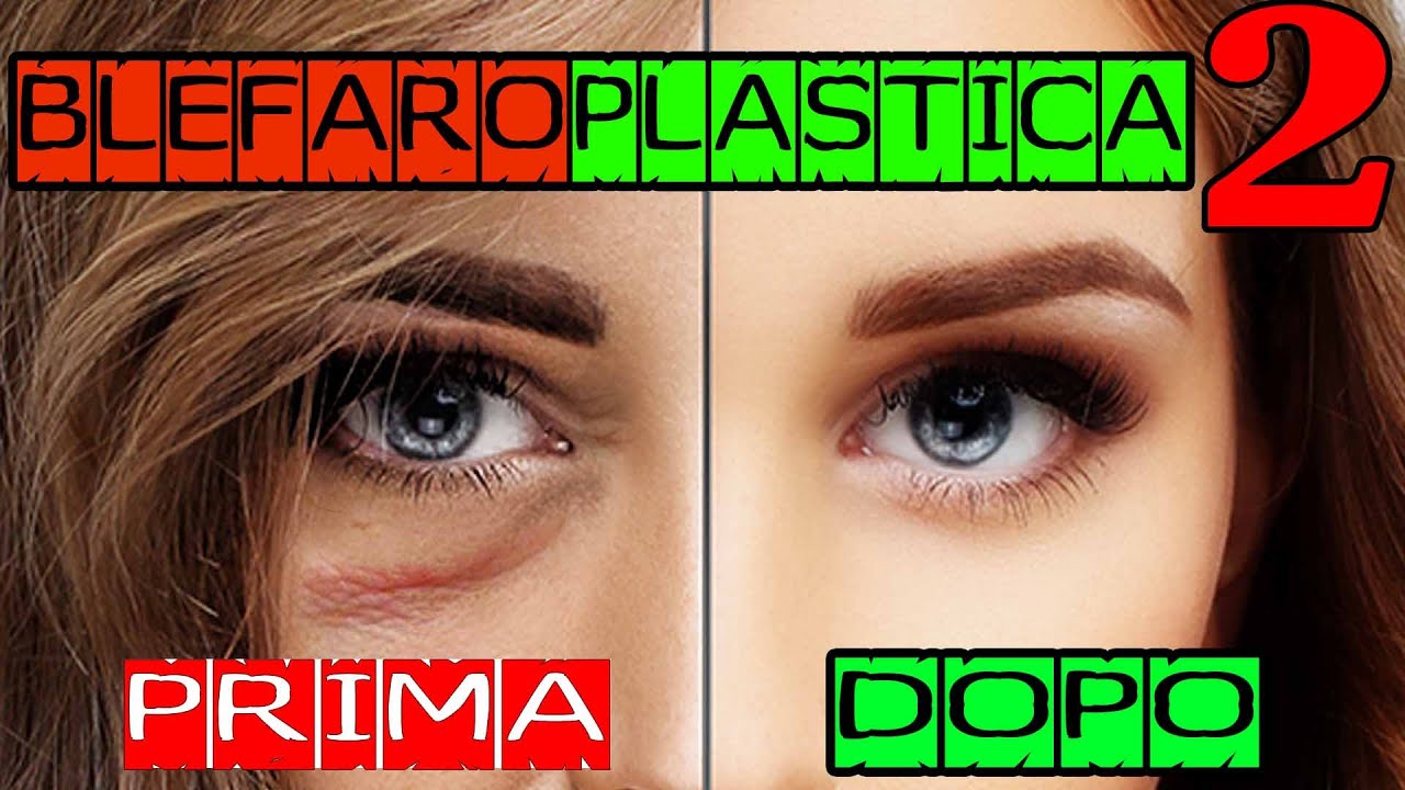 BLEFAROPLASTICA prima e dopo 2. Le NUOVE TECNICHE - Dott. Antonio Distefano