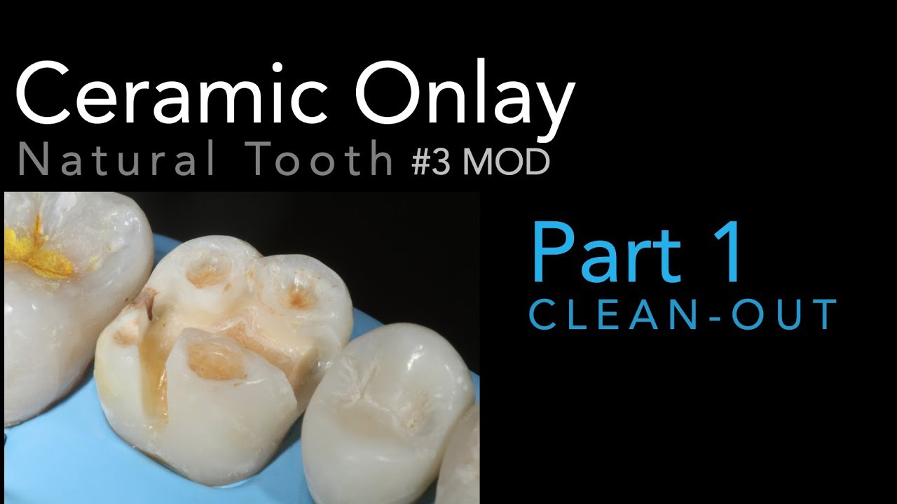Lithium Disilicate Ceramics, Part  1: Ceramic Onlay Clean-Out #3 MOD