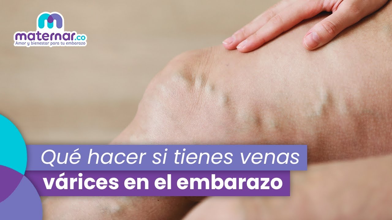Как избежать варикозного расширения вен во время беременности? | Maternar.co