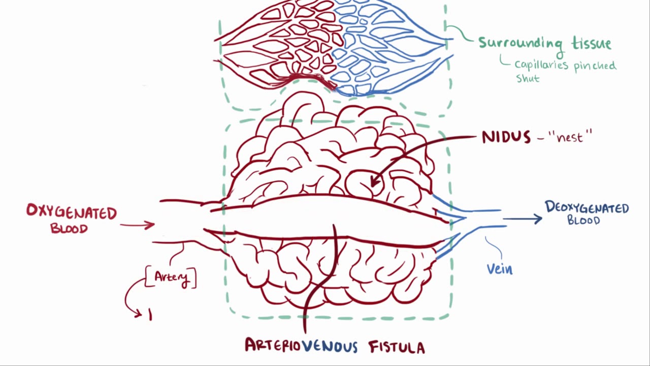 Arteriovenous malformation AVM   causes, symptoms, diagnosis, & pathology