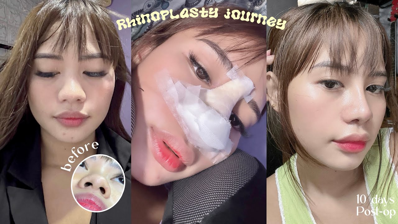 My Rhinoplasty Journey Part 1 (Philippines) 1 week post-op | momshria