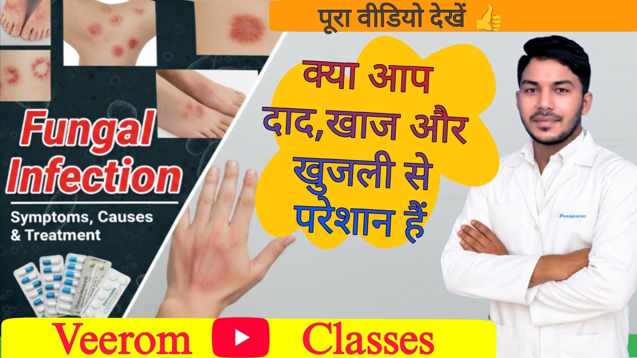 Fungal Infection Causes ,Symptoms, Prevention And Treatment, दाद खाज और खुजली के कारण,बचाव और इलाज 👍