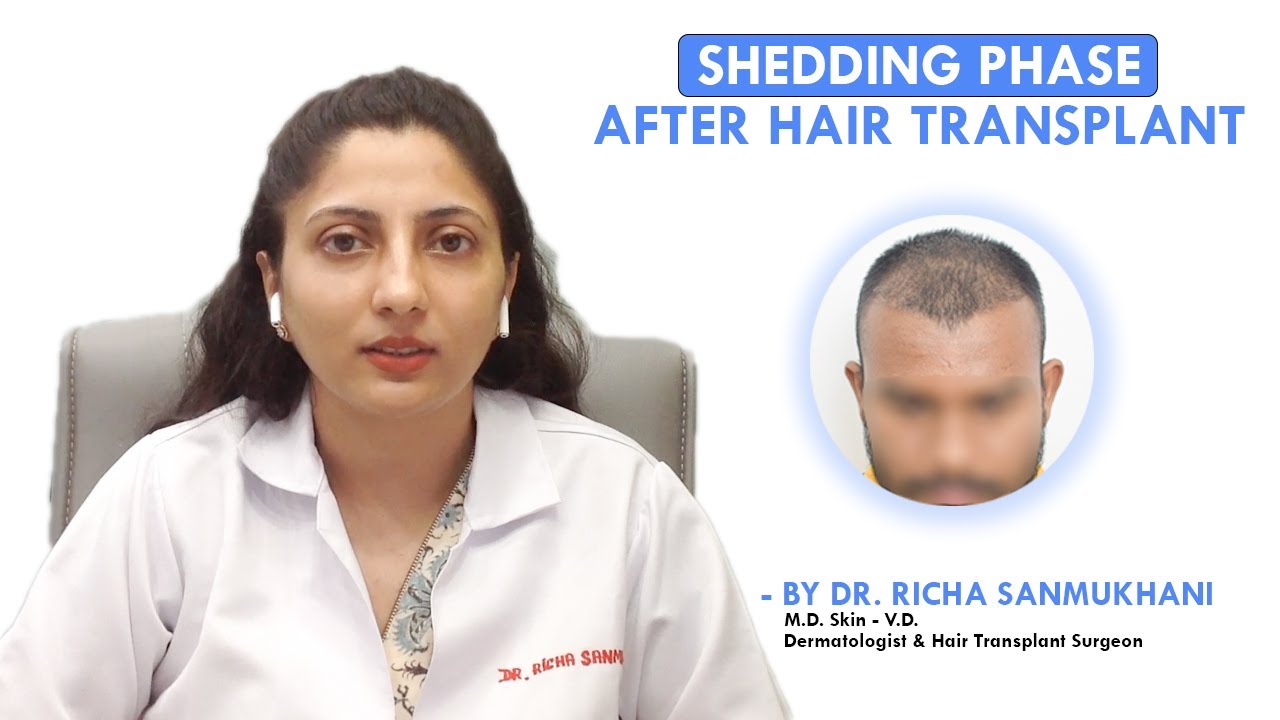 Shedding Phase After Hair Transplant -Explained by Dr. Richa Sanmukhani From Hairfree Hairgrow