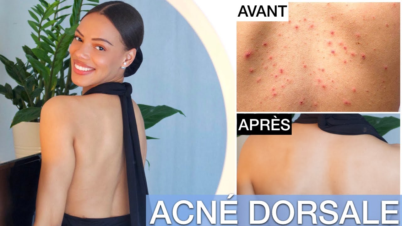 S.O.S: ACNÉ DORSALE | Routine Complète pour s'en débarrasser !
