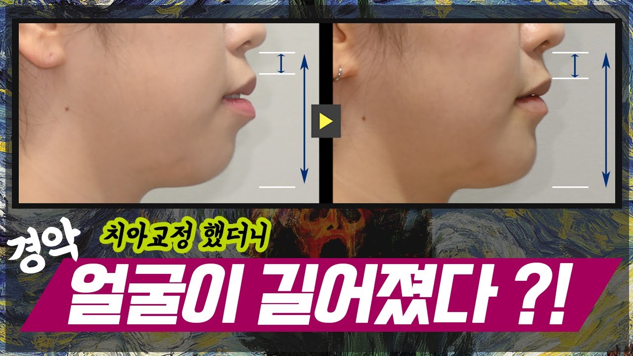 #치아교정 했더니 #얼굴길이 길어졌어요?!  #얼굴작아지는법  #치아교정얼굴변화 #치아교정전후 #인중축소